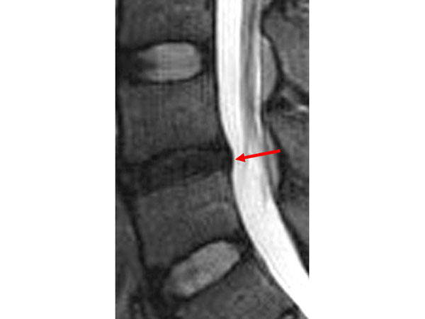 Протрузия и грыжа межпозвоночного диска на МРТ | Грыжа диска (межпозвоночная грыжа), лечение у доктора Бубновского